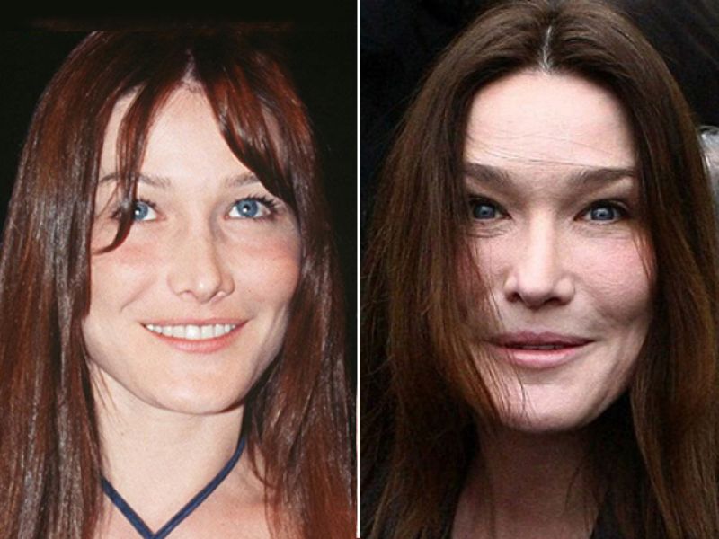 botox-carla-bruni2